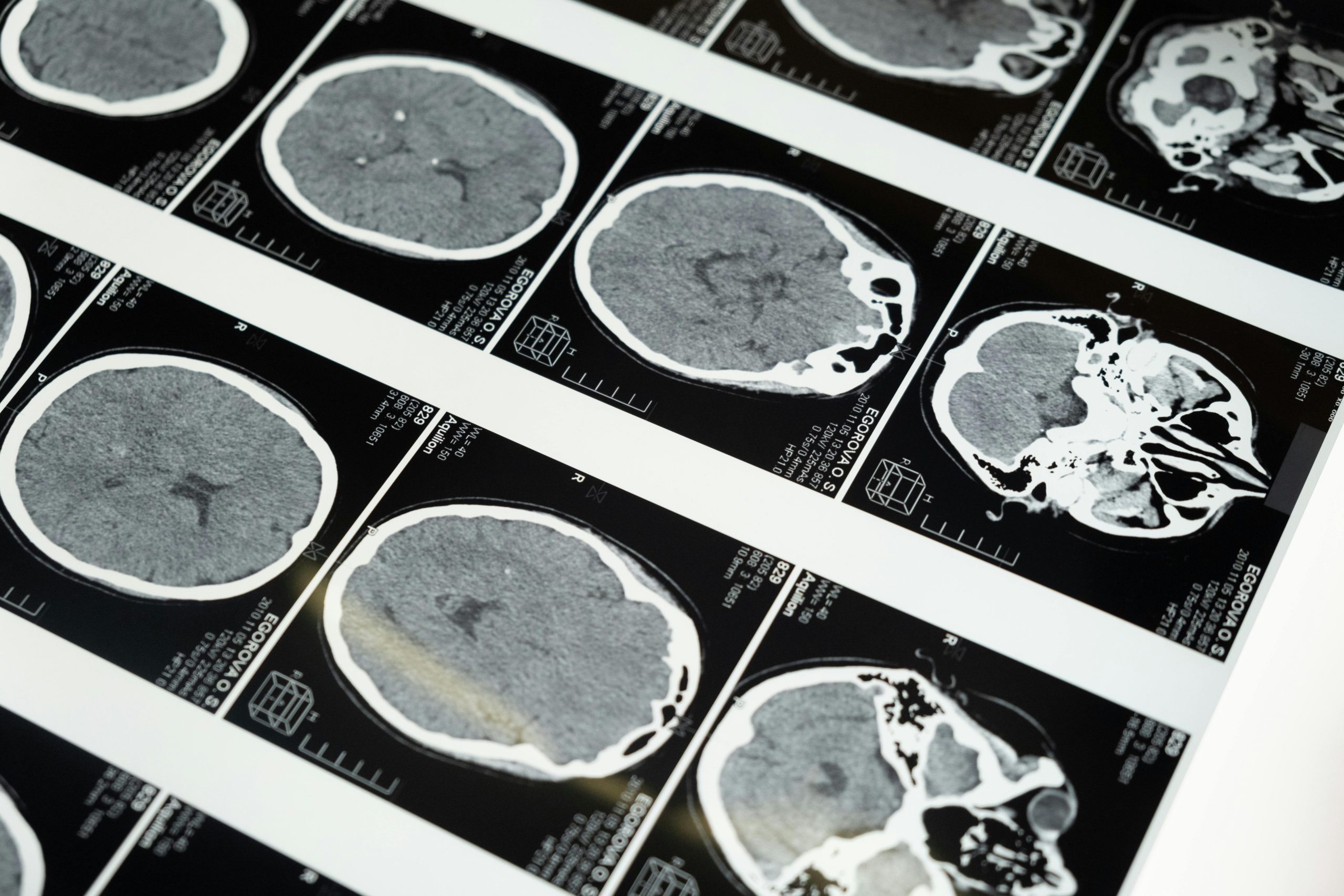 Train Your Amygdala: Exercises For Anxiety Relief That Rewire The Alarm System